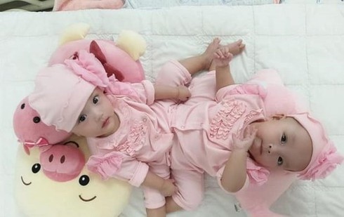 Conjoined twin girls to be separated in HCM City on July 15